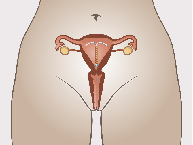 Koperspiraal geplaatst in de baarmoeder