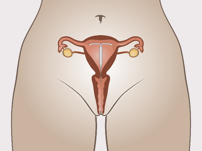 hormonaal spiraal ingebracht