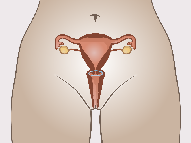 Vaginale ring in de vagina